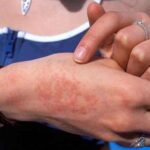 چند توصیه برای جلوگیری از ابتلا به «تب مالت» چند توصیه برای جلوگیری از ابتلا به «تب مالت»