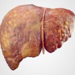 ۹ روش برای درمان کبد چرب ۹ روش برای درمان کبد چرب