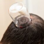 حجامت باعث افزایش قد میشود؟ حجامت باعث افزایش قد میشود؟