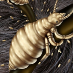 هشدار مقاومت دارویی شپش و بینتیجهبودن درمان دارویی هشدار مقاومت دارویی شپش و بینتیجهبودن درمان دارویی