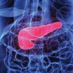 علائم و عوارض سنگ کیسه صفرا علائم و عوارض سنگ کیسه صفرا