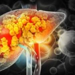 کبد چرب چند گرید دارد و علائم هر کدام چیست؟ کبد چرب چند گرید دارد و علائم هر کدام چیست؟