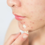 خواص گوگرد در مراقبت از پوست