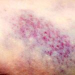 زود کبود شدن بدن نشانه چیست؟ زود کبود شدن بدن نشانه چیست؟