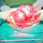 خارج کردن رحم ۳ کیلویی از شکم یک زن خارج کردن رحم ۳ کیلویی از شکم یک زن