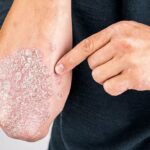 ویتامین‌های مناسب برای کنترل پسوریازیس