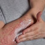 کدام غذاها علائم پسوریازیس را تشدید یا تسکین می‌دهند؟