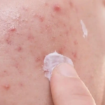 ویتامینی که بیماری پوستی را رفع می‌کند