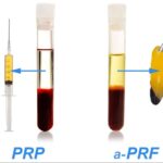 PRF چیست و چه تفاوتی با PRP دارد؟