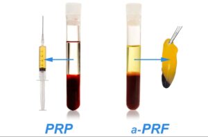 PRF چیست و چه تفاوتی با PRP دارد؟