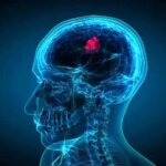 قطره بینی که تومورهای کشنده مغز را کوچک میکند قطره بینی که تومورهای کشنده مغز را کوچک میکند