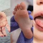 آیا تب برفکی در انسان خطرناک است؟ تفاوت آن با تب برفکی حیوانات را بدانید! آیا تب برفکی در انسان خطرناک است؟ تفاوت آن با تب برفکی حیوانات را بدانید!