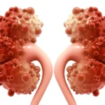 چرا کیست کورتیکال کلیه ایجاد میشود و چه زمانی خطرناک است؟ چرا کیست کورتیکال کلیه ایجاد میشود و چه زمانی خطرناک است؟