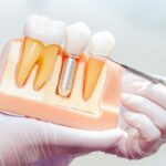 ایمپلنت اقساطی دندان با بهترین مواد و متخصص در شهریار