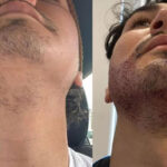 چرا بعضی کاشت های ریش مصنوعی به نظر می رسند؟ چرا بعضی کاشت های ریش مصنوعی به نظر می رسند؟