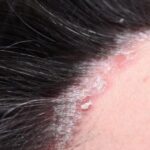 پسوریازیس چیست و چگونه آن را درمان کنیم؟ پسوریازیس چیست و چگونه آن را درمان کنیم؟