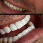 لمینت بهتر است یا کامپوزیت و نکاتی که باید بدانید لمینت بهتر است یا کامپوزیت و نکاتی که باید بدانید