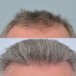 آیا کاشت موی جوگندمی امکان پذیر است؟ آیا کاشت موی جوگندمی امکان پذیر است؟