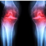 داروی جدیدی که می تواند آرتروز را درمان کند