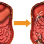با علائم، علل و راه‌های تشخیص چسبندگی روده آشنا شوید