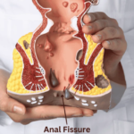 شقاق مقعدی چیست و چرا ایجاد می‌شود؟ بررسی علائم و روش‌های درمان