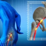 روش‌های غیردارویی درمان سیاتیک؛ از تحرک تا اصلاح سبک زندگی
