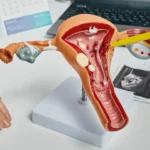 پولیپ رحم چیست؟ از علائم و دلایل ایجاد تا جدیدترین روش‌های درمان قطعی