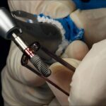 ایمپلنت دندان؛ بهترین راه ‌حل جایگزینی دندان از دست ‌رفته با حفظ زیبایی لبخند