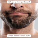 بهترین دکتر کاشت ریش و سبیل | راهنمای کامل داشتن ریش پرپشت و طبیعی