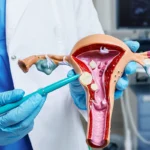 میوم رحم چیست؛ علائم، عوارض و روش‌های درمان فیبروم رحم